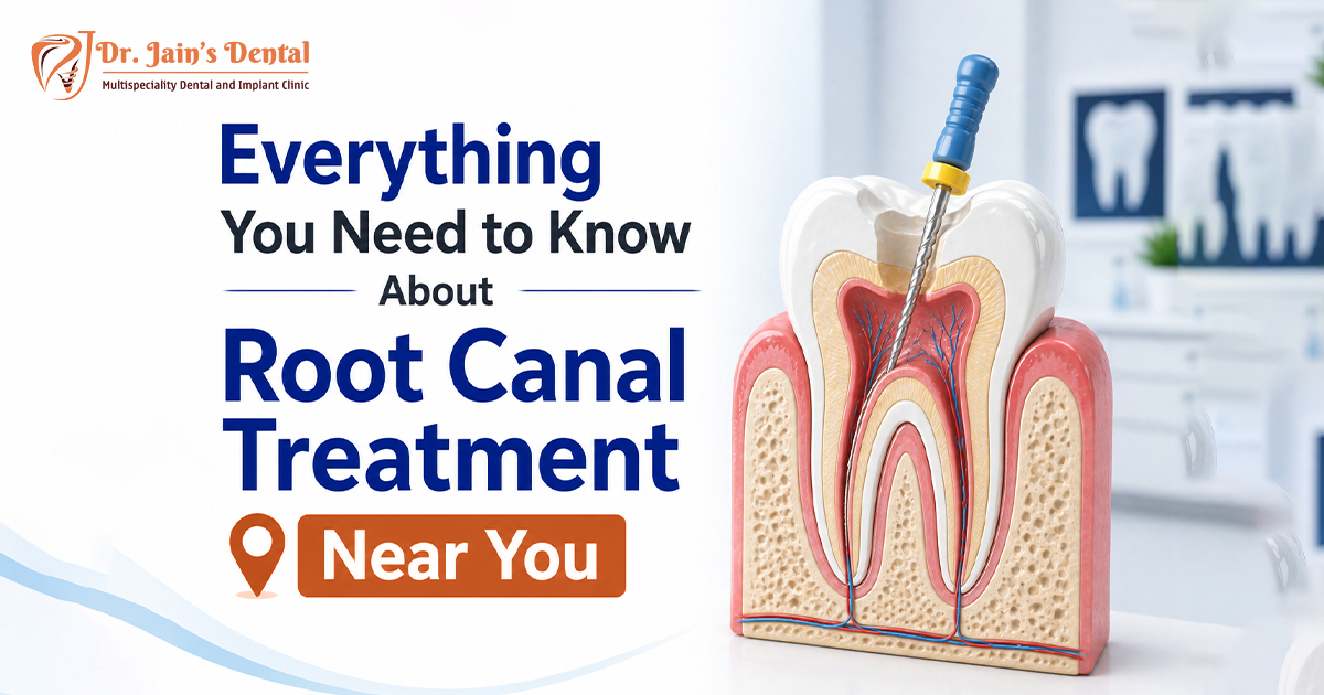 Everything You Need to Know About Root Canal Treatment Near You